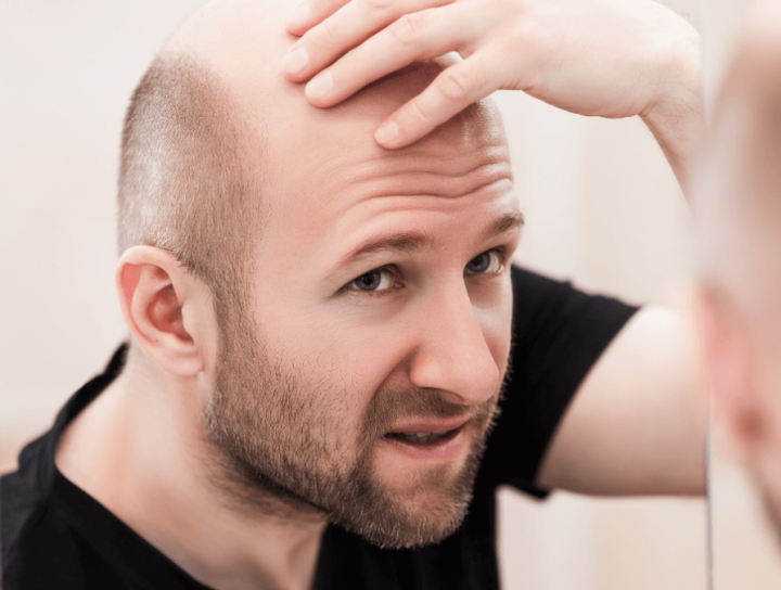 Baldness Treatment in Bandra