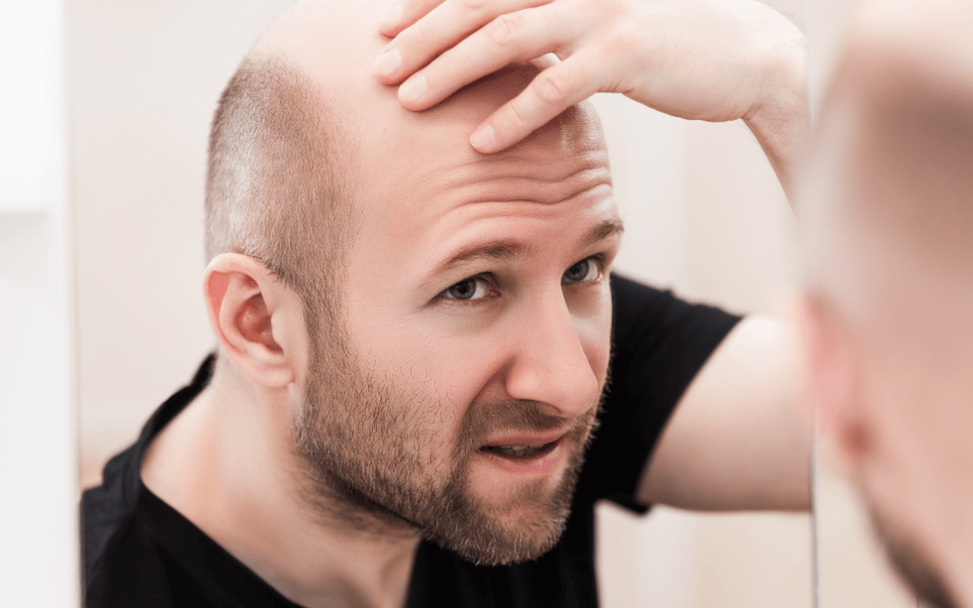 Baldness Treatment in Bandra