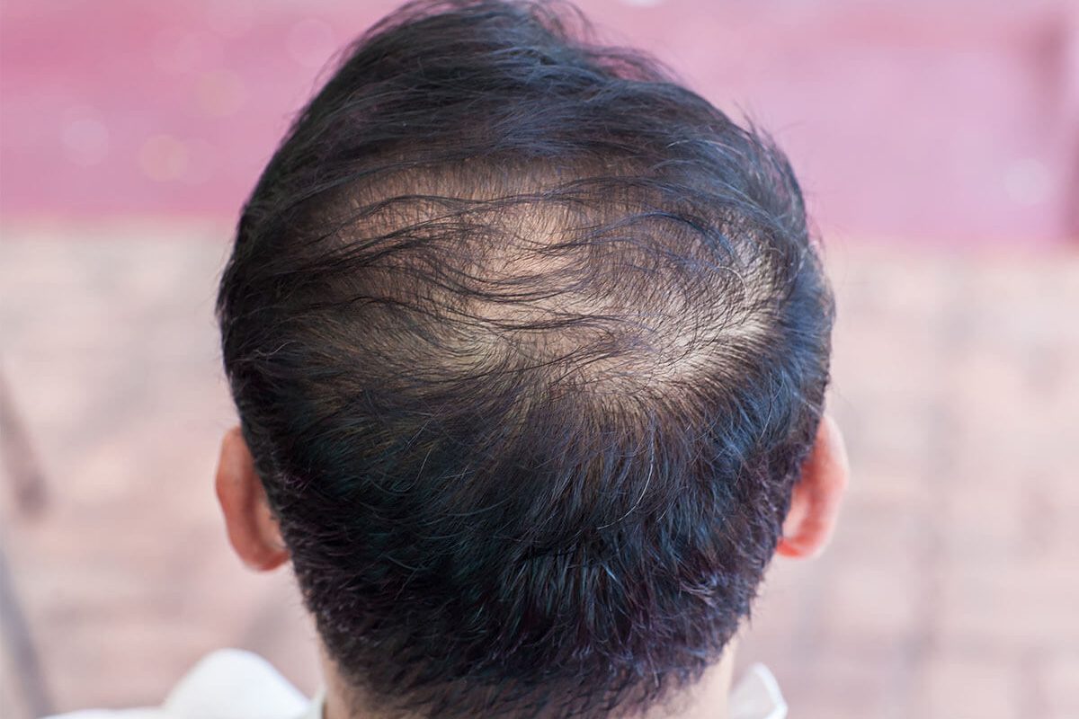 Hair Loss Treatment in Bandra & Mulund