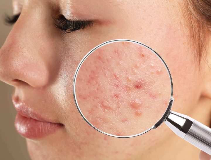 Acne clear Treatment and Acne scar Treatment
