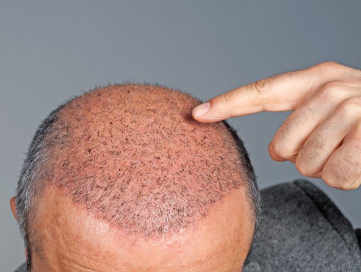 Hair Transplant in Mulund