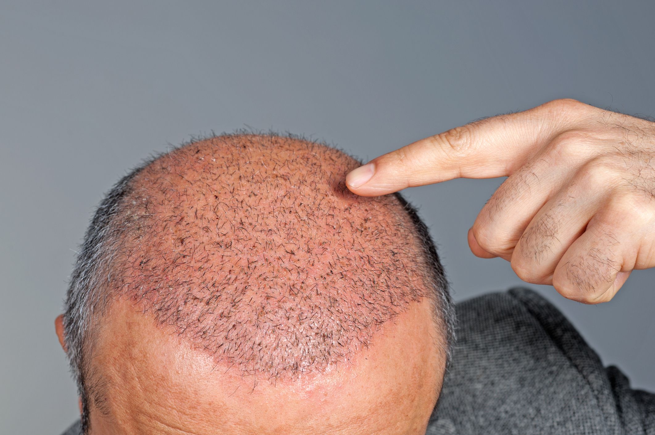 Hair Transplant in Mulund