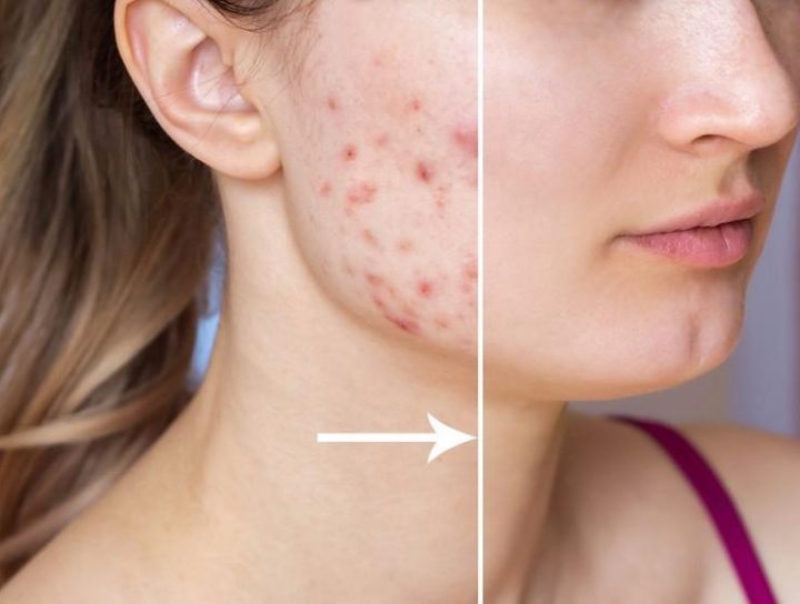 Acne Clear Treatment in Bandra