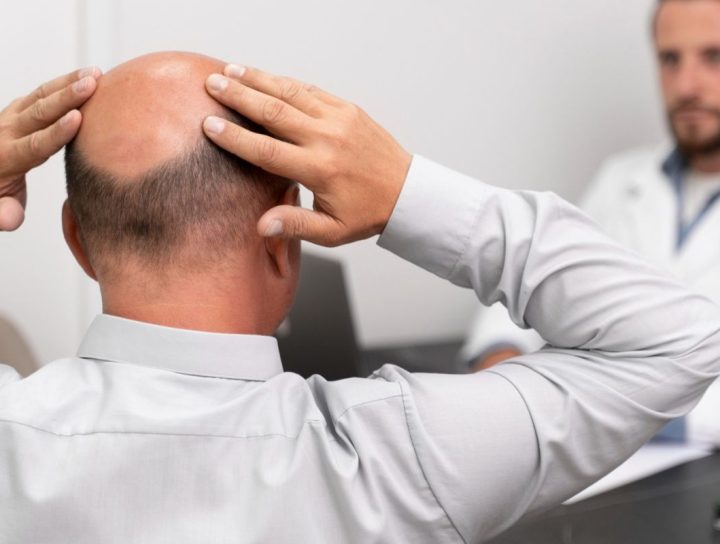 Baldness Treatment in Bandra, Mumbai