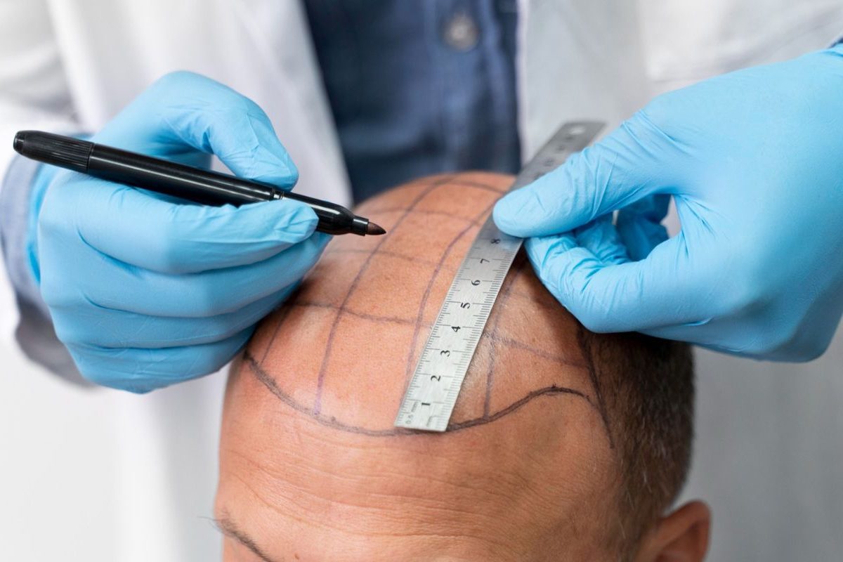 Best Hair Transplant in Mulund, Mumbai