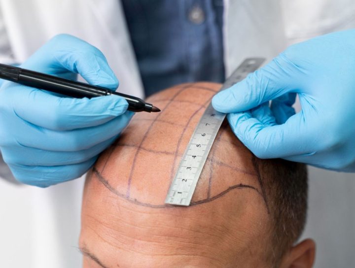 Best Hair Transplant in Mulund, Mumbai