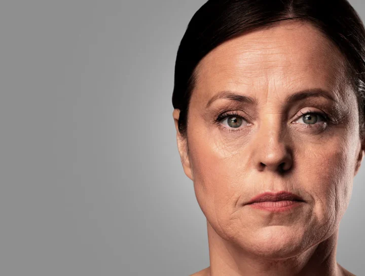 Wrinkle treatment in Bandra